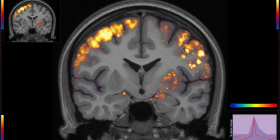How to rewire your brain to manage chronic pain